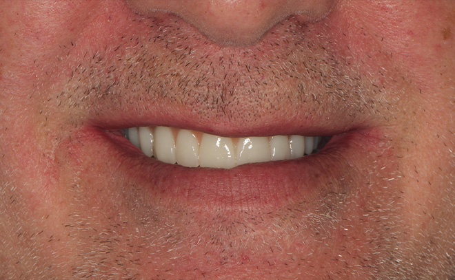 Eastern Pines Dental | Sleep Apnea, Botox® Treatments for Jaw Pain and All-on-X Hybrid Dentures