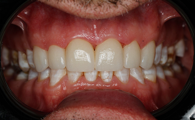 Eastern Pines Dental | Sleep Apnea, Botox reg  Treatments for Jaw Pain and All-on-X Hybrid Dentures