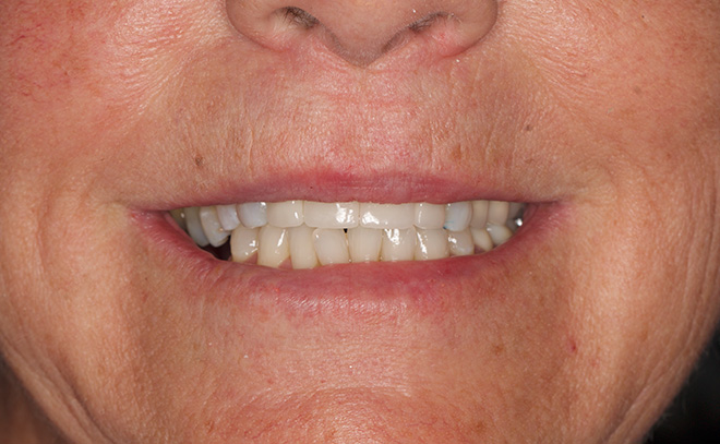 Eastern Pines Dental | Sleep Apnea, Botox® Treatments for Jaw Pain and All-on-X Hybrid Dentures